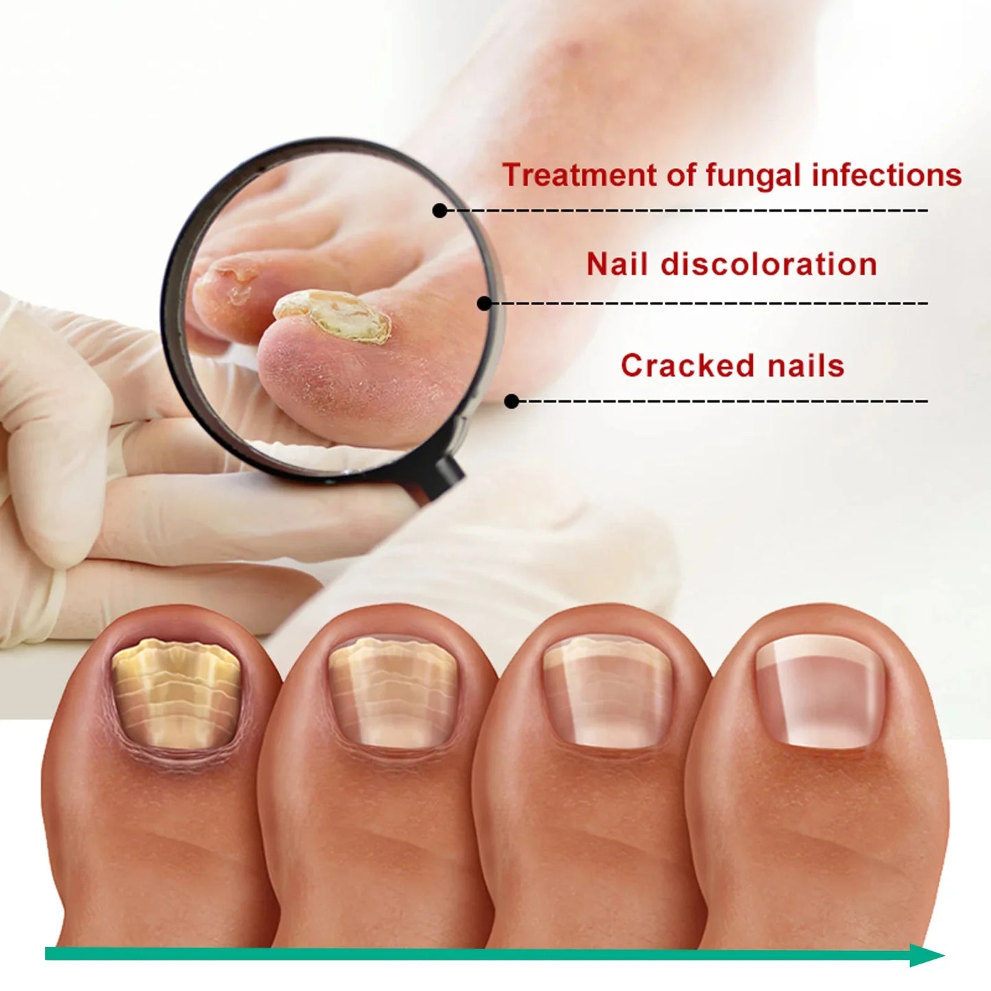 Nail fungus treatment gel |Herbal nail polish foot protection care oil