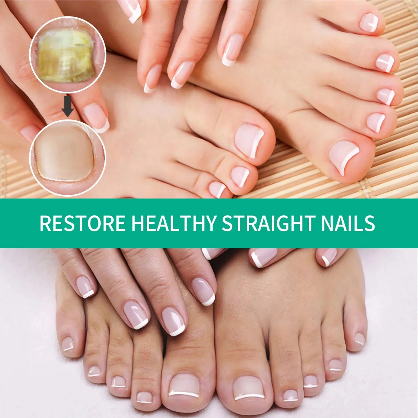 Nail fungus treatment gel |Herbal nail polish foot protection care oil