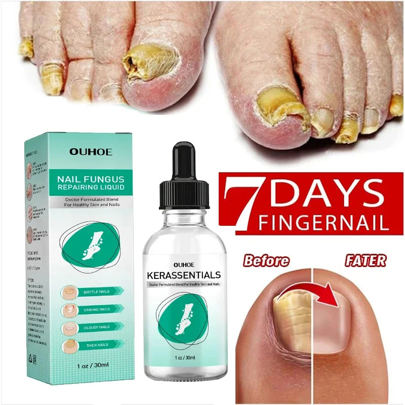 Nail fungus treatment gel |Herbal nail polish foot protection care oil