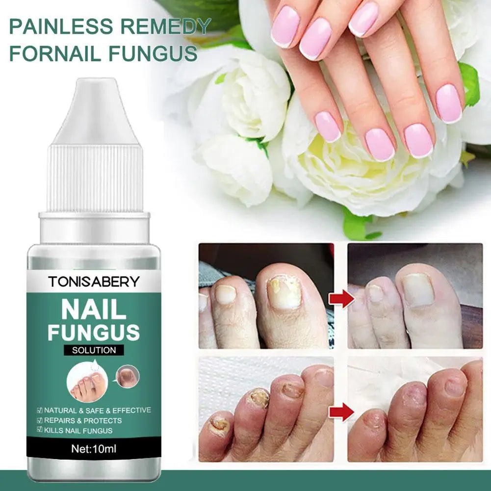 Nail Fungal Treatment Anti Infection Onychomycosis Removal